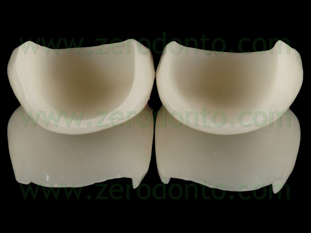 [97-veneers-ceramica-vetrosa3.jpg]