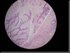 fibroadenoma high resolution histology slide tsnaps fibroadenoma high resolution histology slide tsnaps