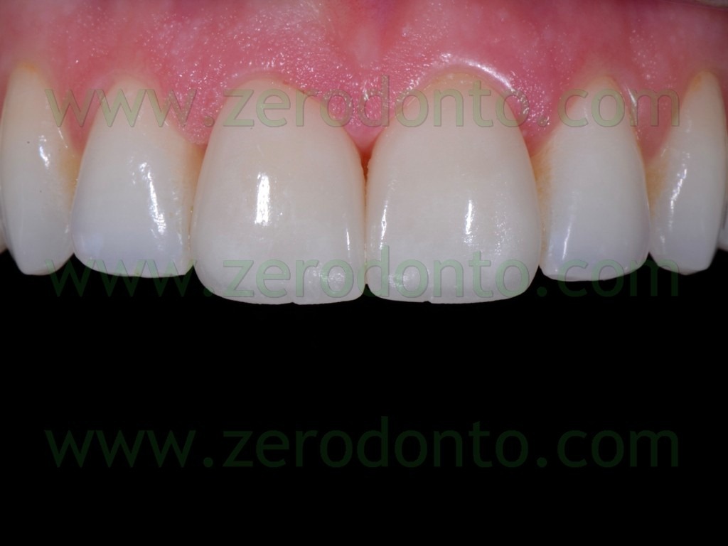 [123-cementazione-estetica-faccette-c.jpg]