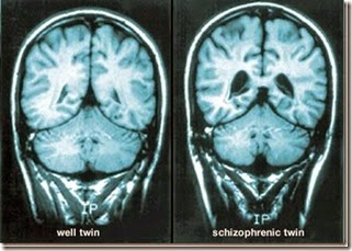 webmd_rf_photo_of_mri_brain_scans_thumb[2]