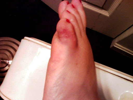 broken toe. Broken Toe My roken toe!