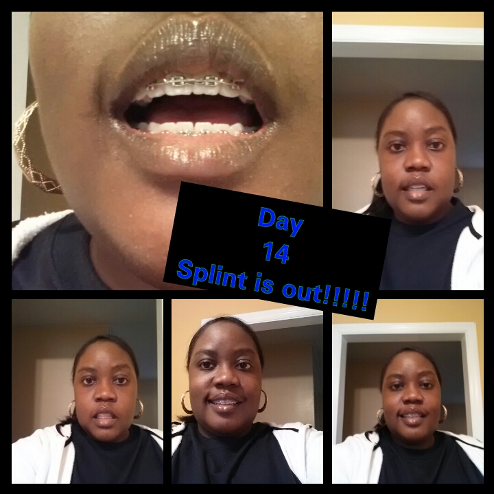 FROM BRACE FACE 2 JAW SURGERY 2013 HERE I COME!!!!! Followup