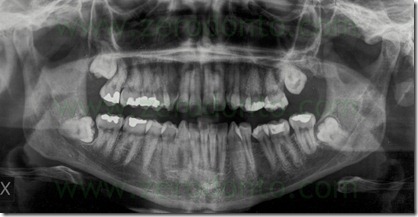 1 radiografia panoramica ottavo incluso
