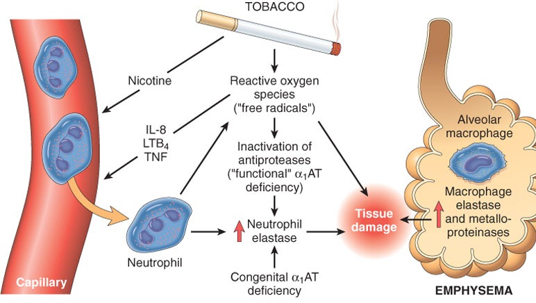 [patho%2520emphysema%255B6%255D.jpg]