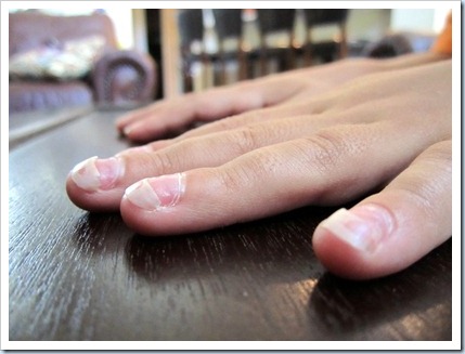 Steece S Pieces Ben Fingernails Are Falling Off 07 July 2017 184