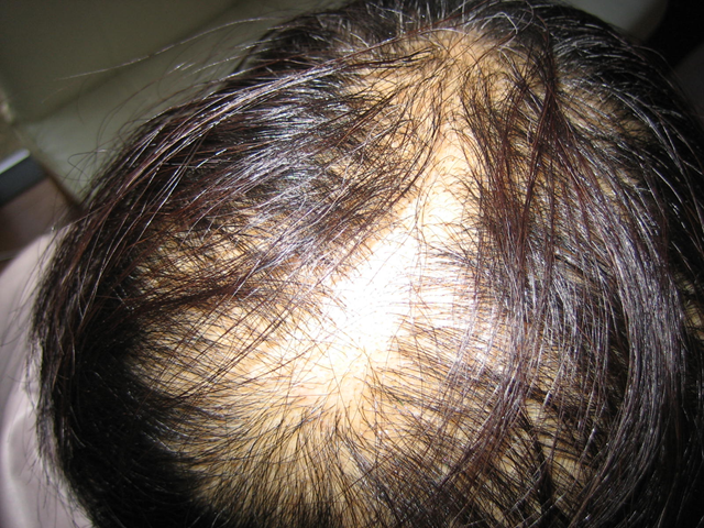 Sudden hair loss in a woman who lives in Minami Soma and was exposed to Fukushima fallout. Numayu no blog http://blogs.yahoo.co.jp/kmasa924