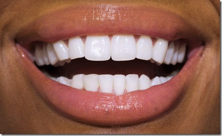 teeth whitening4