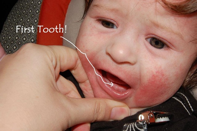 [tooth%255B6%255D.jpg]