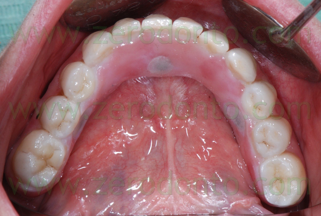 [zirconia-bridge2.jpg]
