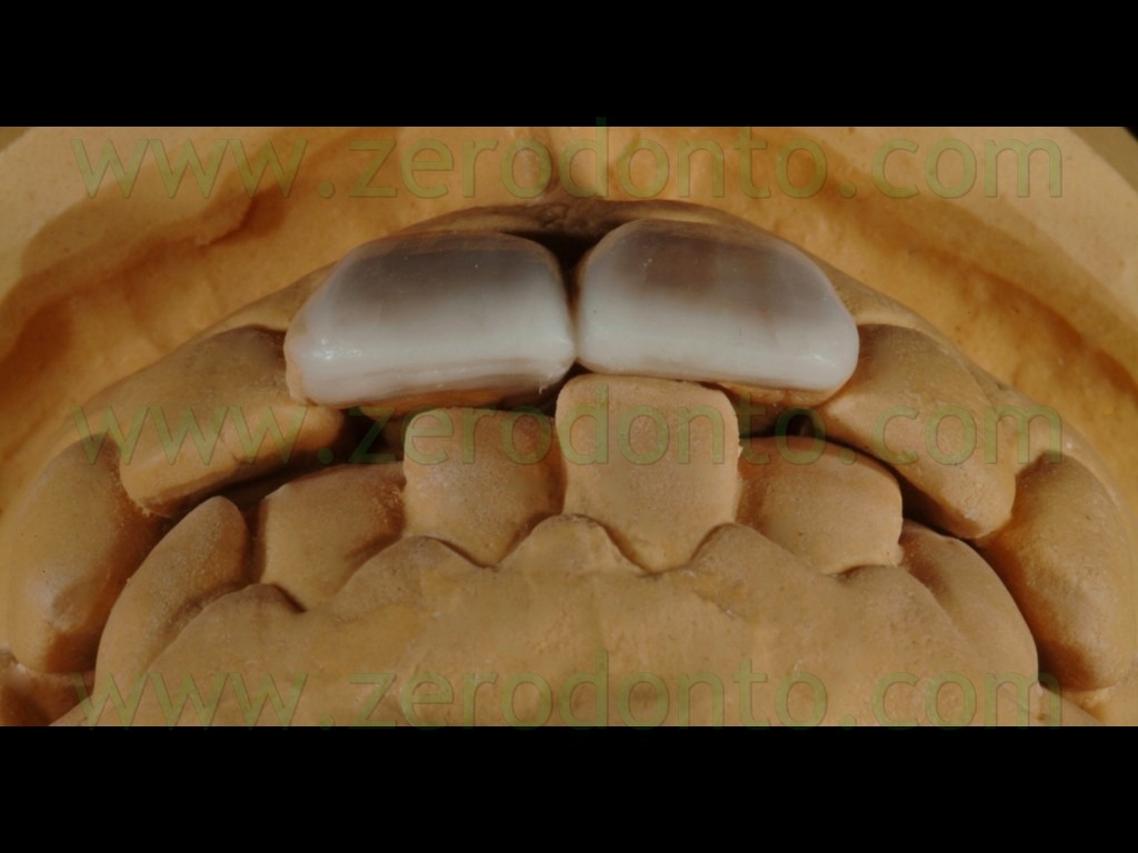 [13-wax-up3.jpg]