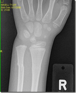bones 1 bones 1