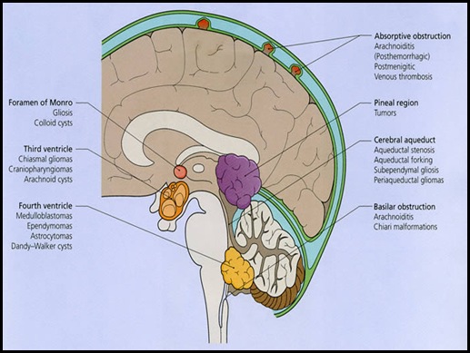 hydrocephalus_csf_Medical show blog