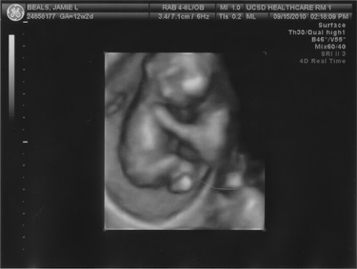 3D ultrasound 12 weeks 3d ultrasound pictures at 12 weeks. 3D ultrasound 12 weeks