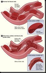 sickle_cell_01