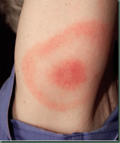 Lyme disease and other tick borne bacterial diseases  BADA UK21