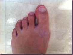 hallux valgus4 hallux valgus4
