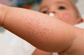 dermatitis-pada-tubuh-bayi