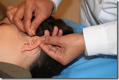 acunputura curitiba acupuntura auricular