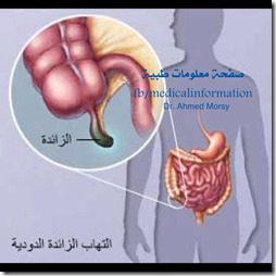 appendicitis appendicitis