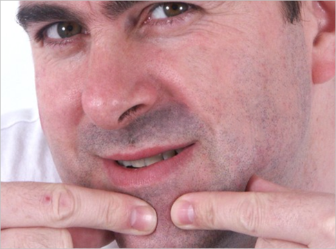 After picture of removing acne in Photoshop After-picture-of-removing-acne-in-Photoshop