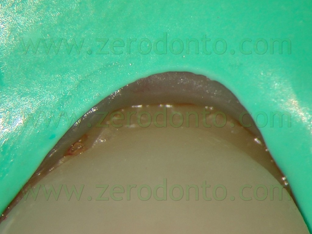 [119-margine-cementazione-cervicale-f.jpg]