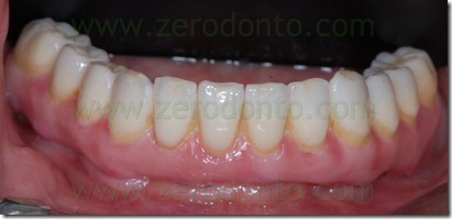 full arch zirconia