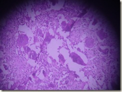 giant tumour photograph histology slide