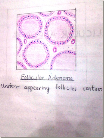 follicular adenoma diagram histopathology