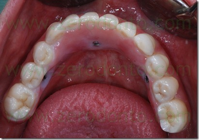 ponte zirconia