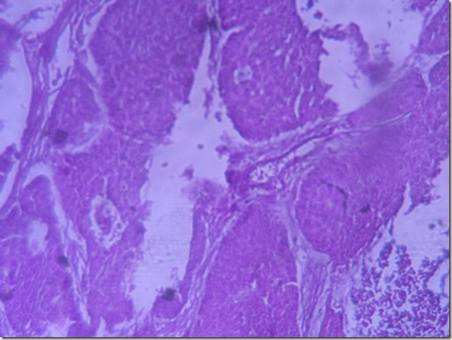 basal cell carcinoma histopathology