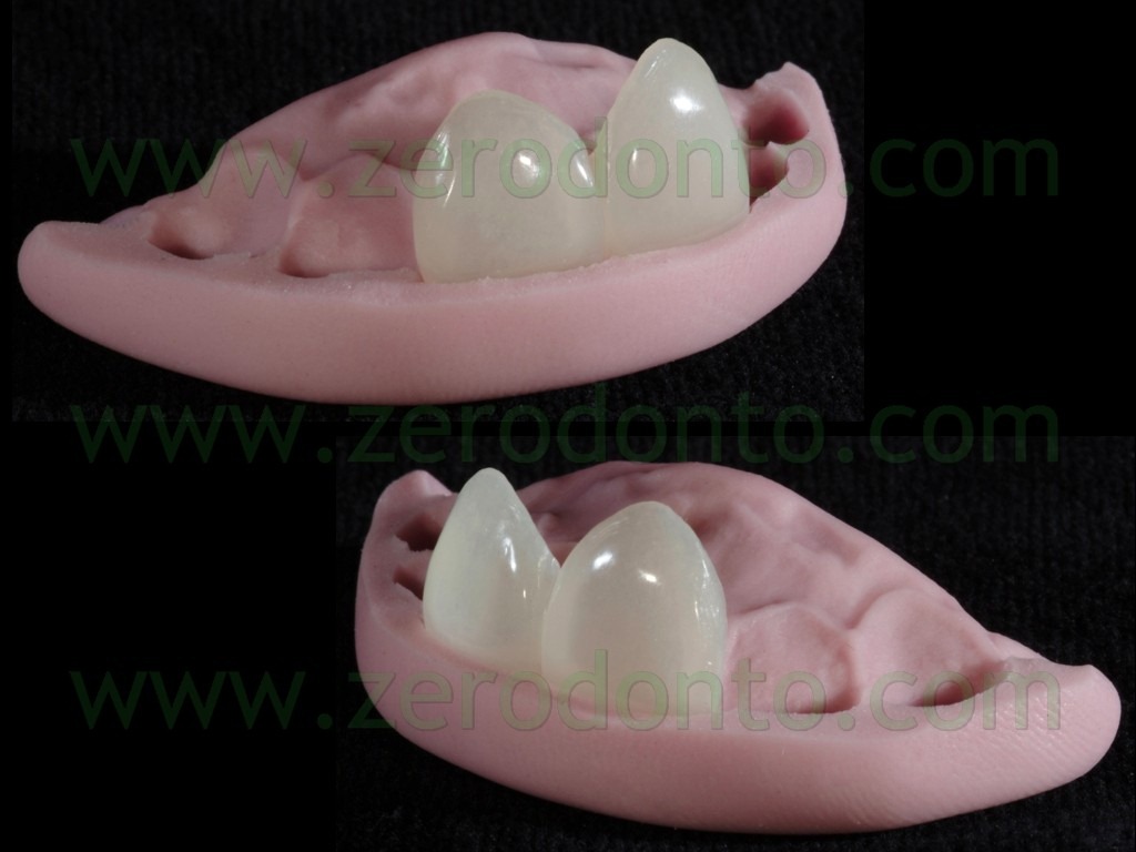 [45-prova-veneers3.jpg]