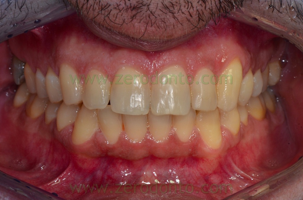 [24%2520overbite%255B2%255D.jpg]