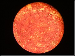 SCC(Squamous cell carcinoma) high resolution histology slide tsnaps SCC(Squamous cell carcinoma) high resolution histology slide tsnaps