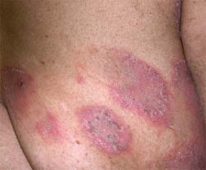 El régimen para la mamá y el niño a atopicheskom la dermatitis