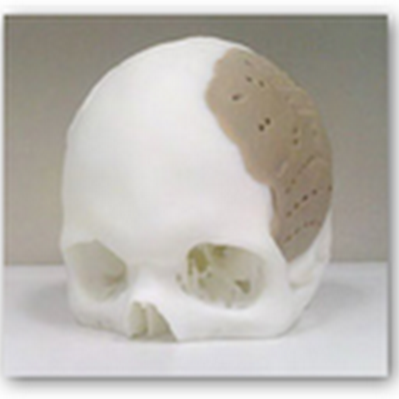 Man Has 75% of His Skull Replaced and Implanted–Replication Done with FDA Approved 3-D Printing Process From OPM