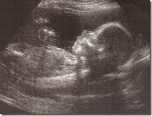 0 US 20wk Mikayla 0 US 20wk Mikayla