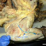femoral_vein_L.JPG