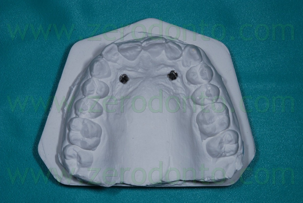 [15%2520miniviti%2520nel%2520modello%2520in%2520gesso%255B2%255D.jpg]