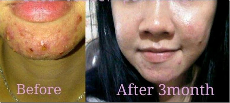 10_Jeunesse-Acne is small matter in Luminesce
