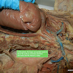 thoracic_aorta_L.JPG