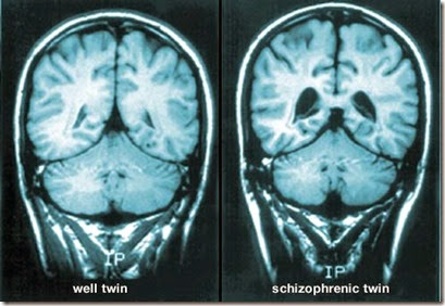 webmd_rf_photo_of_mri_brain_scans