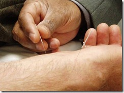 acupuntura curitiba
