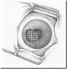 cheratotomia a griglia