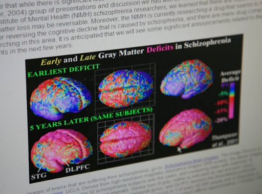 These images show the difference between five years of patients with Schizophrenia, indicating a defecit of brain matter. (Photo credit: Alex Crowder)