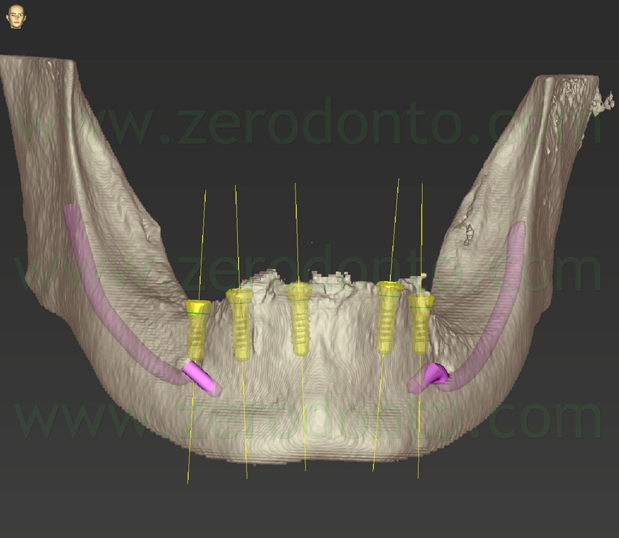 [--73-impianti-roxolid3.jpg]