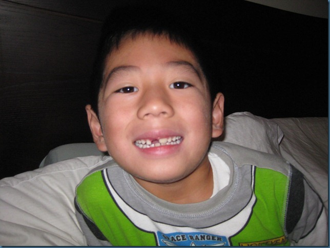 missing_front_tooth