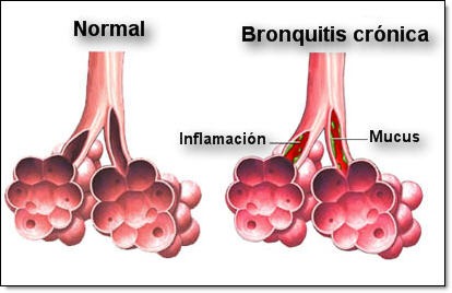 bronquitis bronquitis