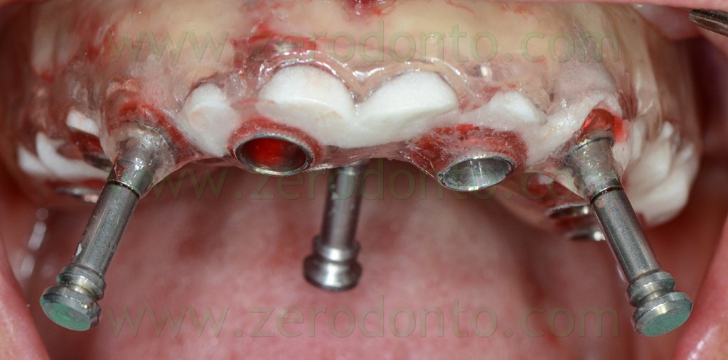 [--232-pin-di-stabilizzazione2.jpg]