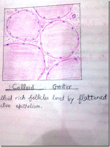 colloid goiter histopathology diagram