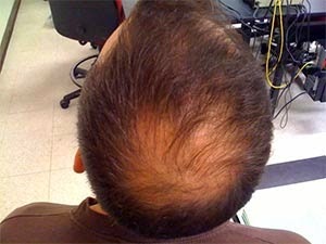 [scalp-inflammation-hair-loss%255B2%255D.jpg]
